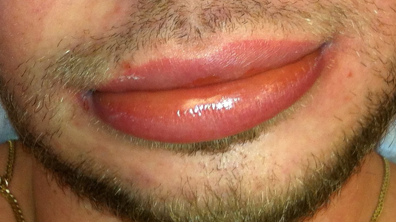 angioedema lips