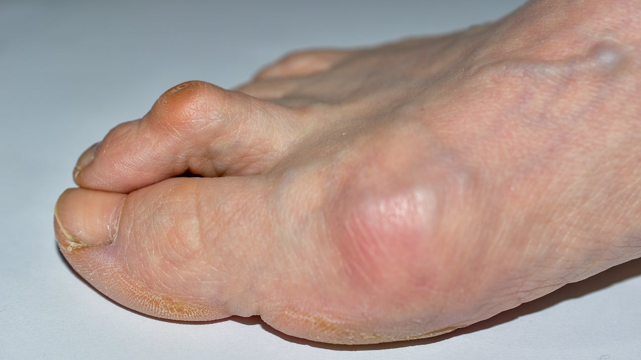 Hammer toe: Causes, symptoms, surgery, and treatment