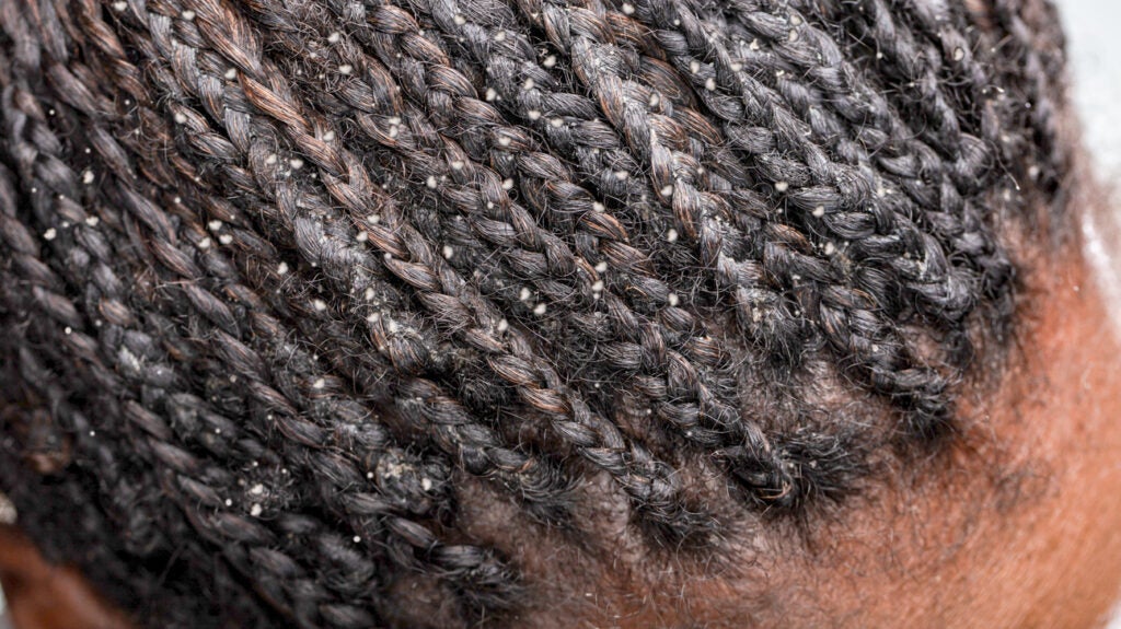 Scalp Psoriasis Vs Dandruff: Symptoms, Pictures, And Causes