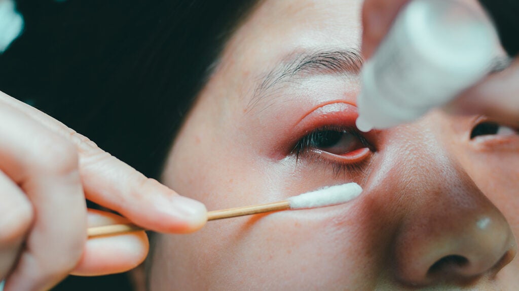 Stye inside eyelid (internal stye) How to identify, and treatments