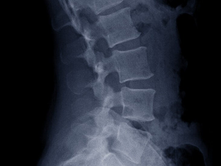 x rayed upper back hump
