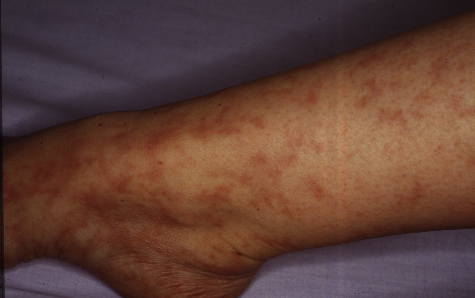 skin (livedo reticularis): Causes, and more