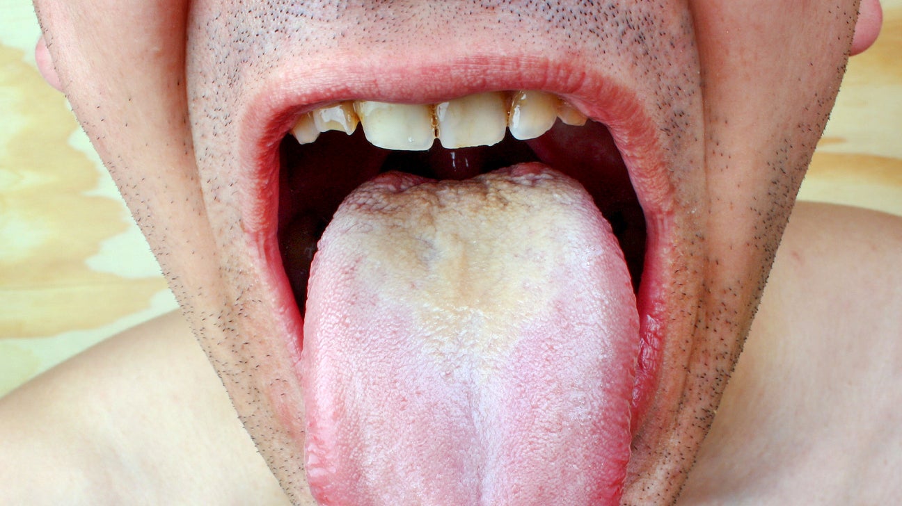 white tongue coating