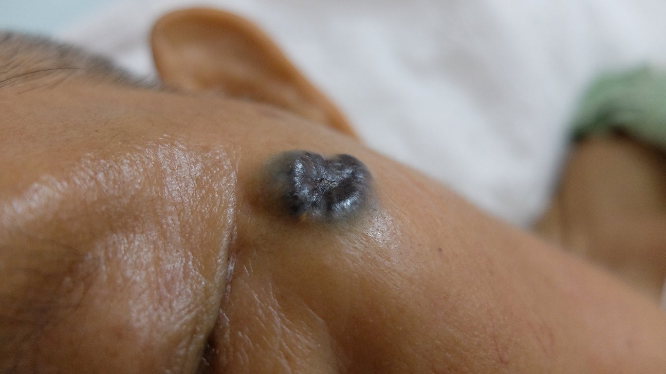 Skin cancer by race and ethnicity: Images and statistics, image size:1296x728