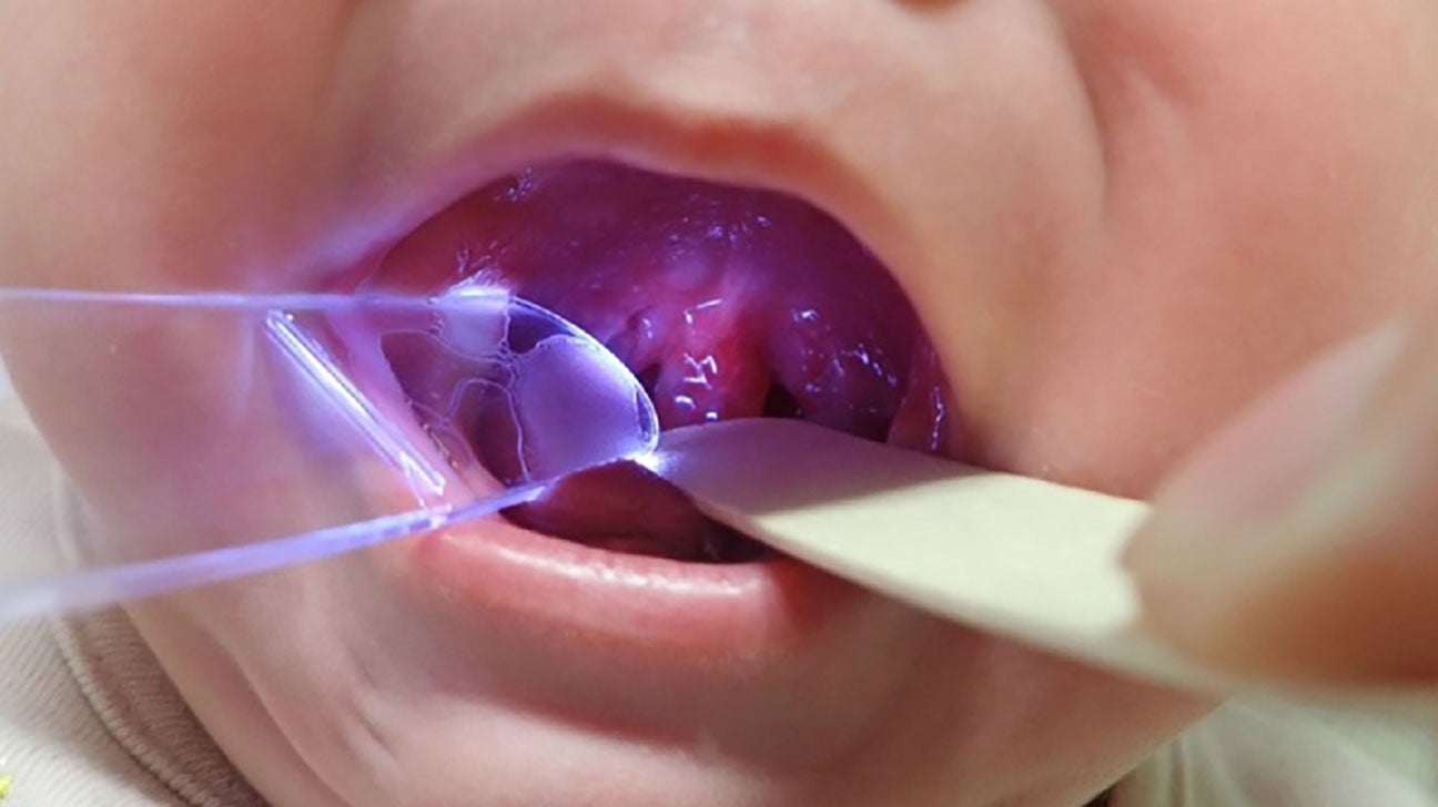 Uvula Cancer
