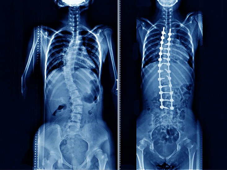 What to know about spinal fusion surgery for scoliosis