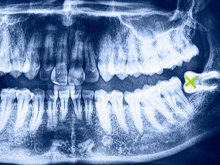 wisdom teeth removal healing process pictures