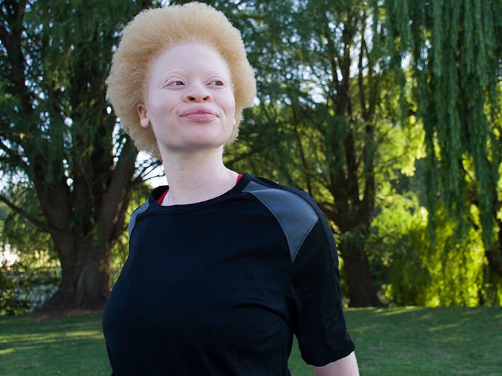 albino black person