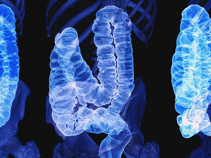 Colon Cancer Symptoms: Detect, Understand, and Prevent