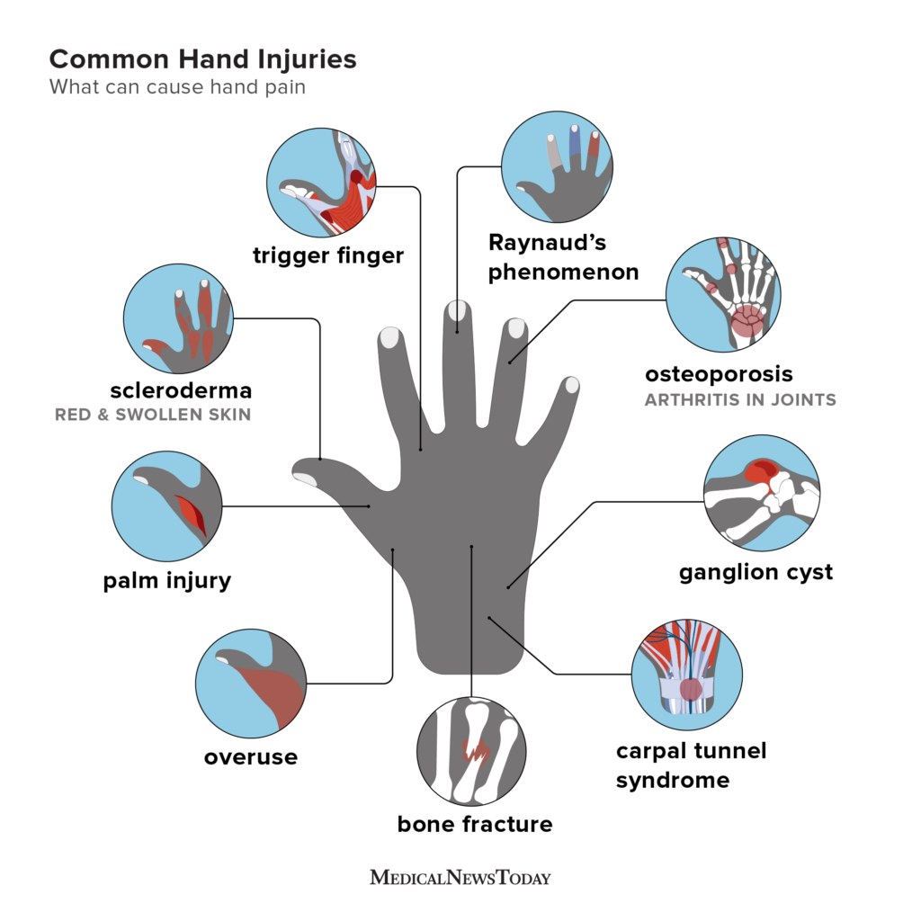 Hand pain: Causes, home remedies, and treatments