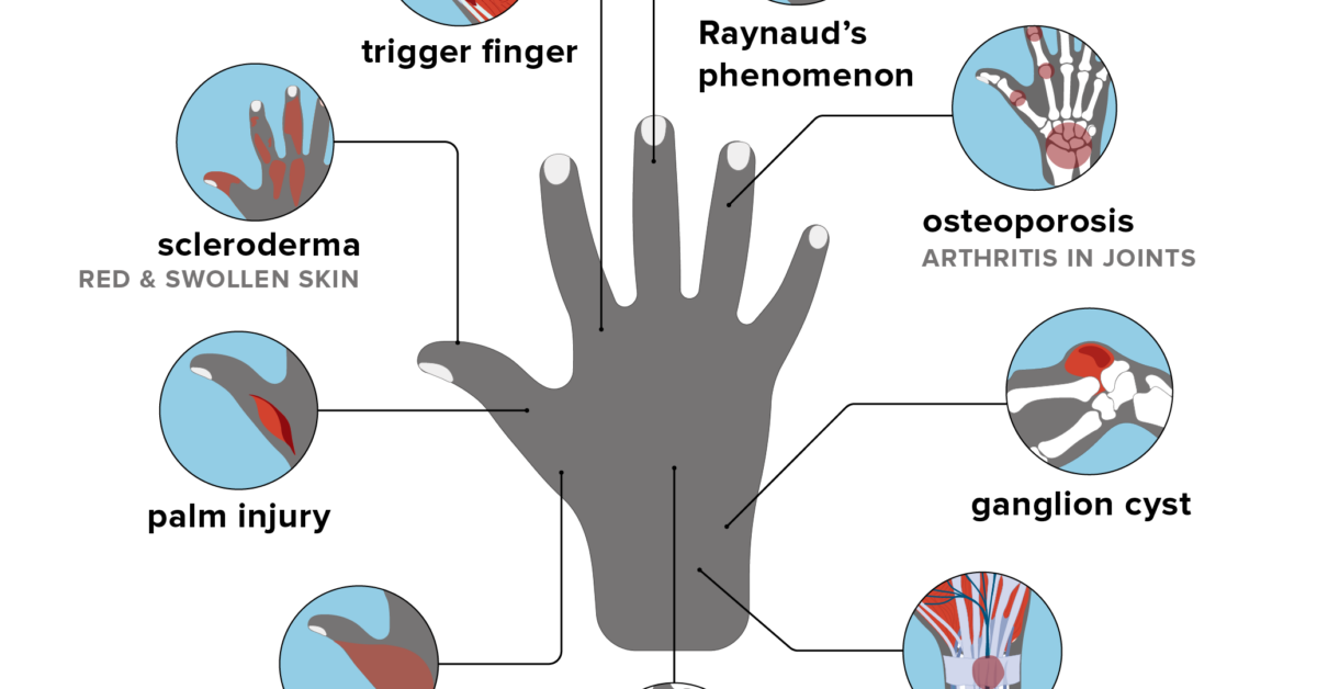 Hand pain: Causes, home remedies, and treatments