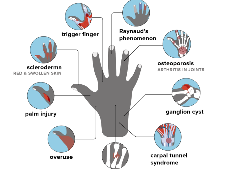 index fingers sore knuckles