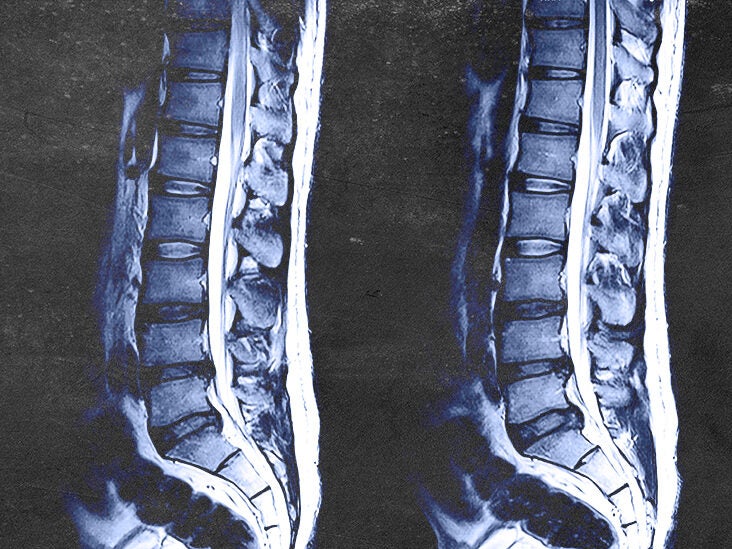 Lumbar MRI Scan: How to read it, how does it take, and more