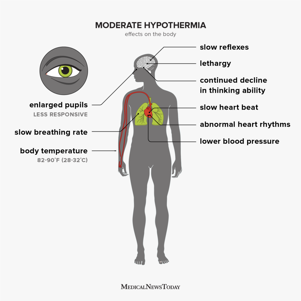 Hypothermia: Symptoms, treatment, stages, and more