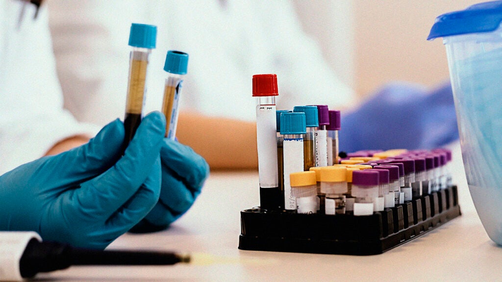 Platelet count blood test: What are high, low, and normal values