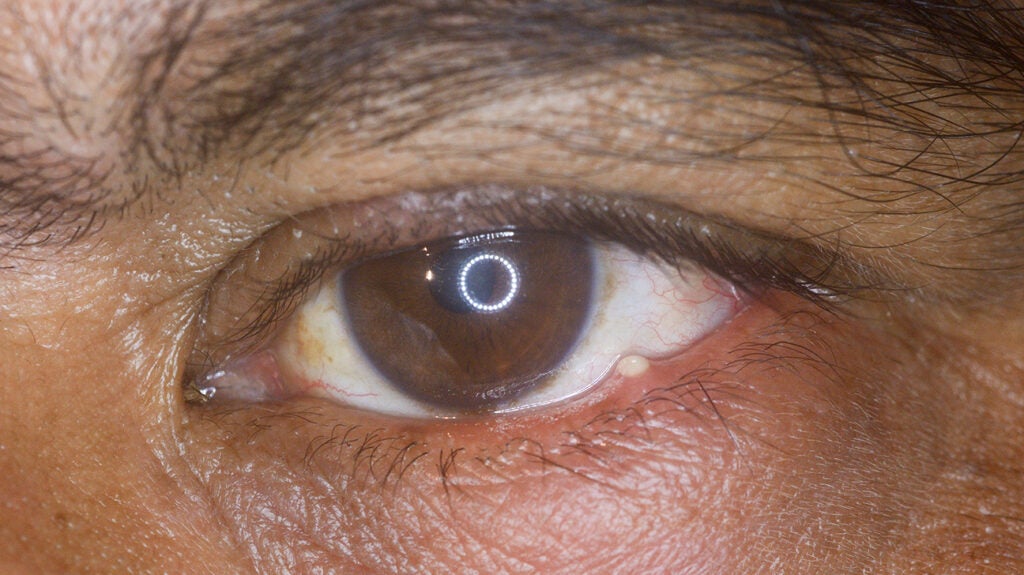 Stye Inside Eyelid Internal Stye How To Identify And Treatments 