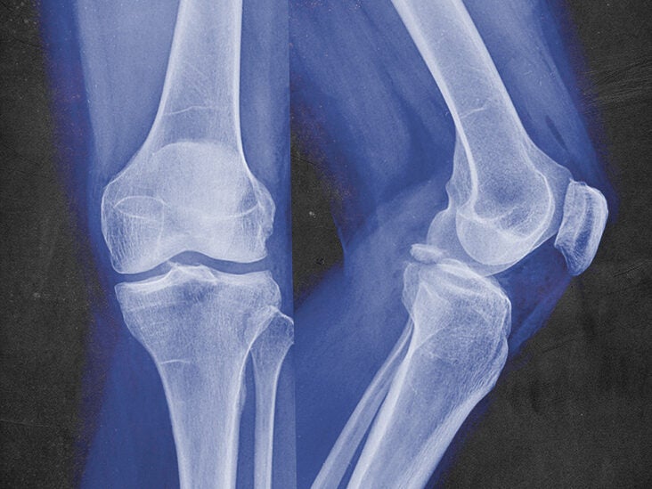 code herfst baas Bone fracture repair: Procedures, risks, and healing time