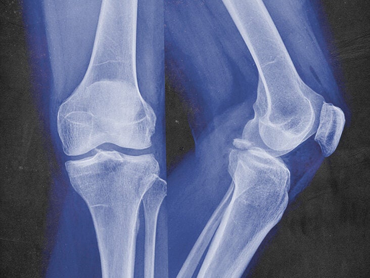 Ankle Fracture: Causes, Symptoms, Treatment and Cost