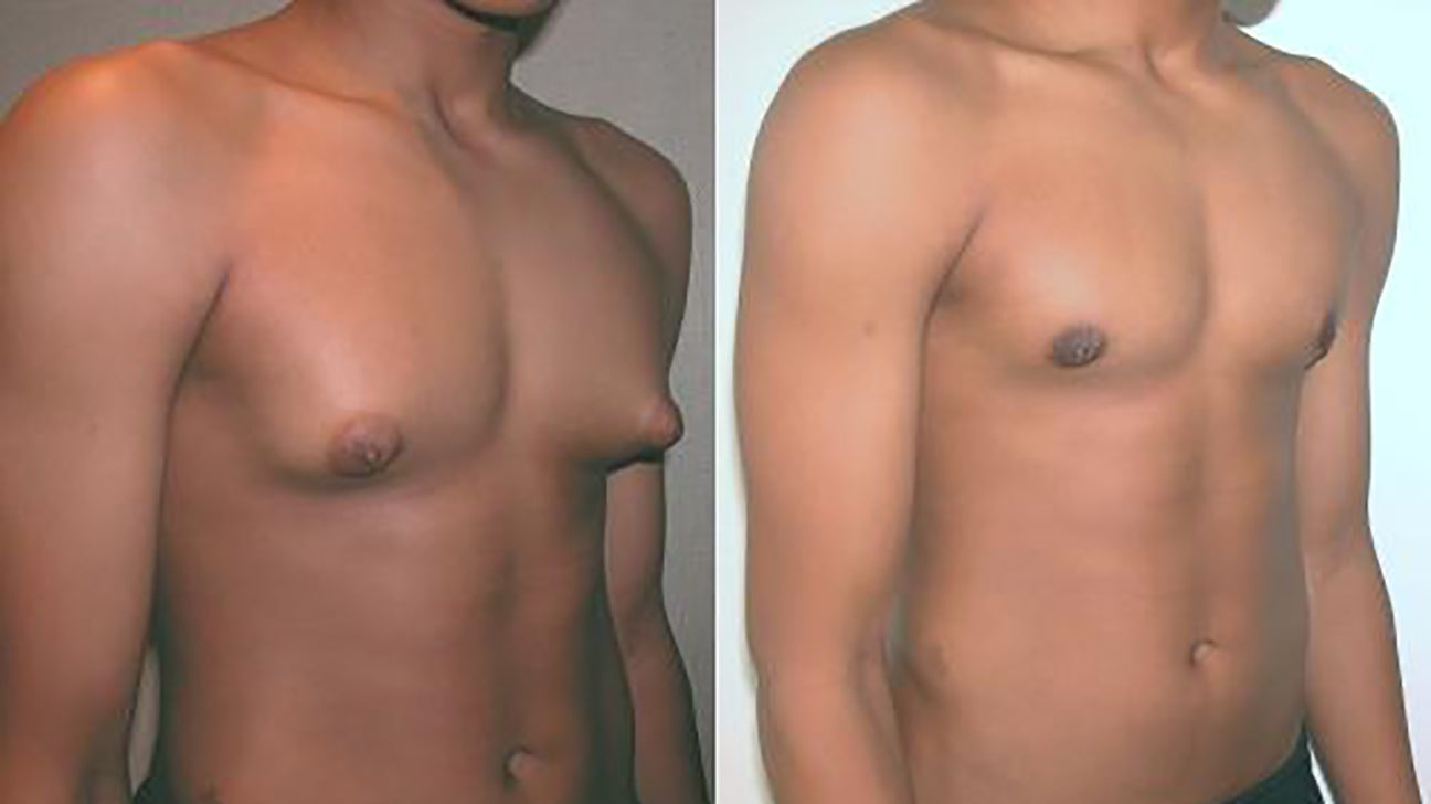 Gynecomastia: Surgery, treatment, causes, and symptoms