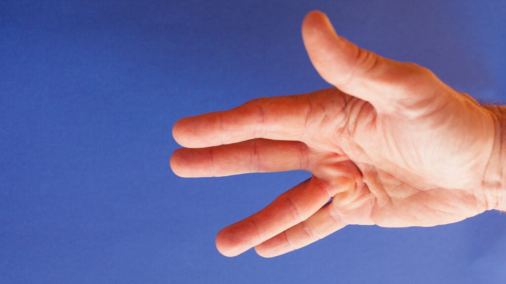 Dupuytren's Contracture: What is it? Symptoms, Causes & Treatment | The Hand Society
