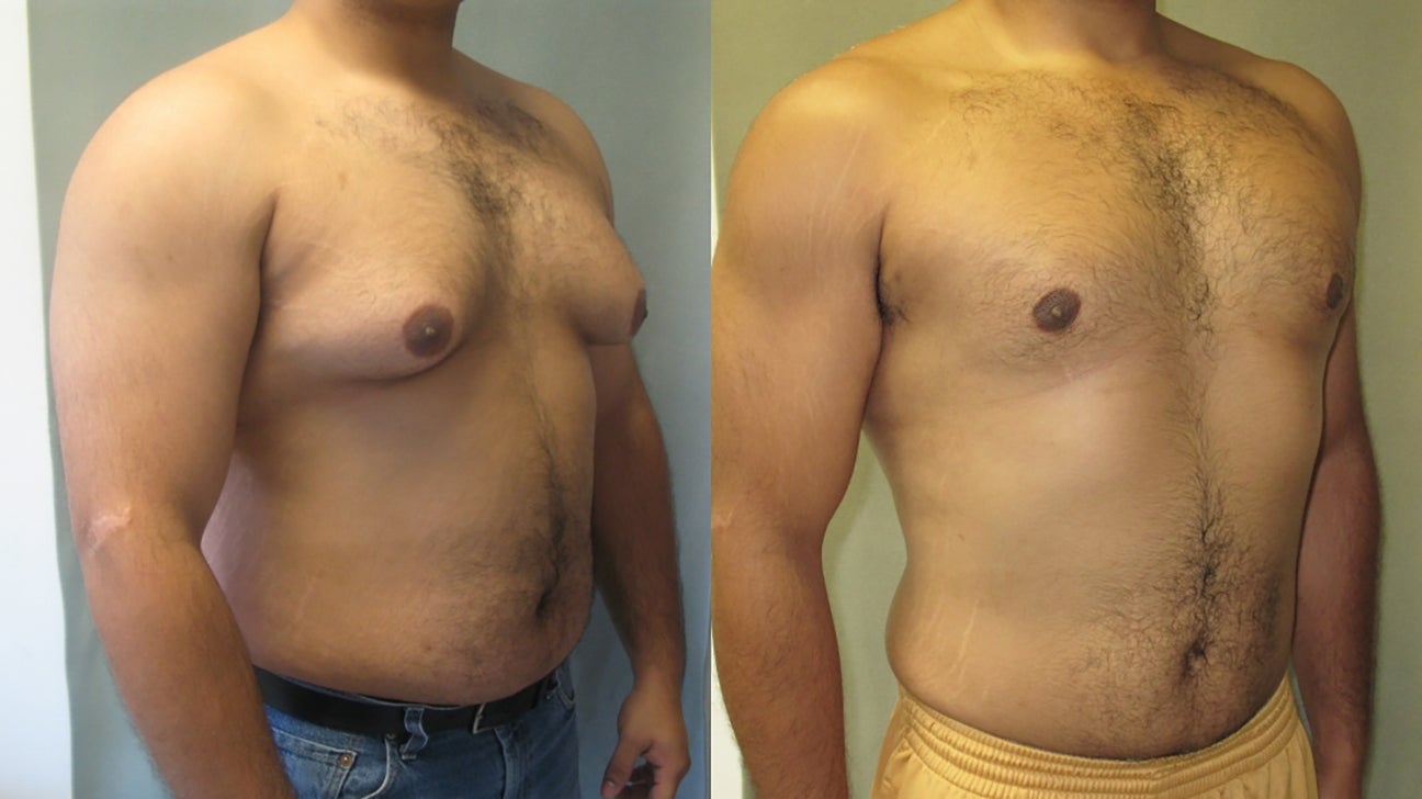 IS GYNECOMASTIA HEREDITARY? DOES IT RUN IN THE FAMILY ?