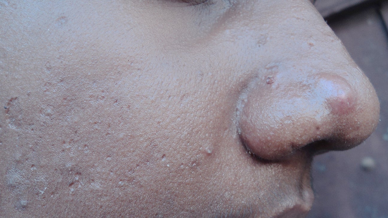 2 Pimples Human Boy 