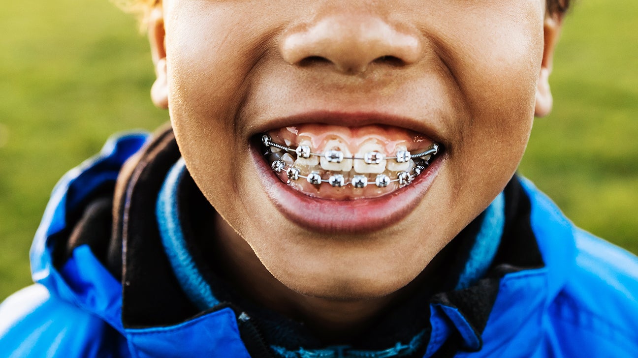 Metal braces: Uses, costs, benefits, and more