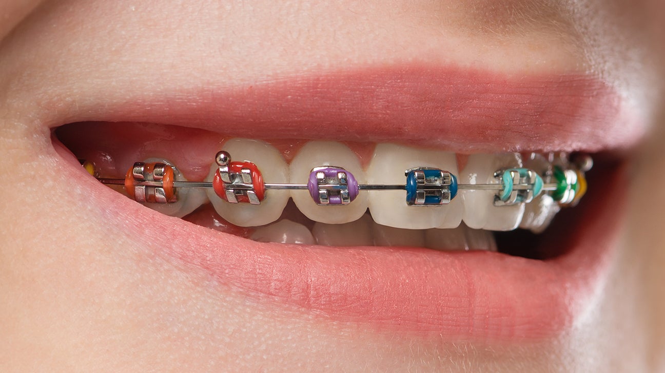 Metal braces: Uses, costs, benefits, and more