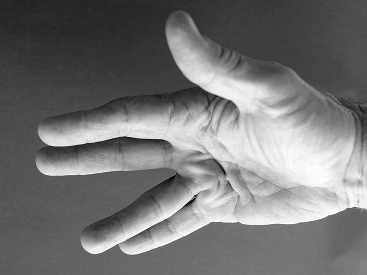 Dupuytren's contracture: Treatment, causes, and more