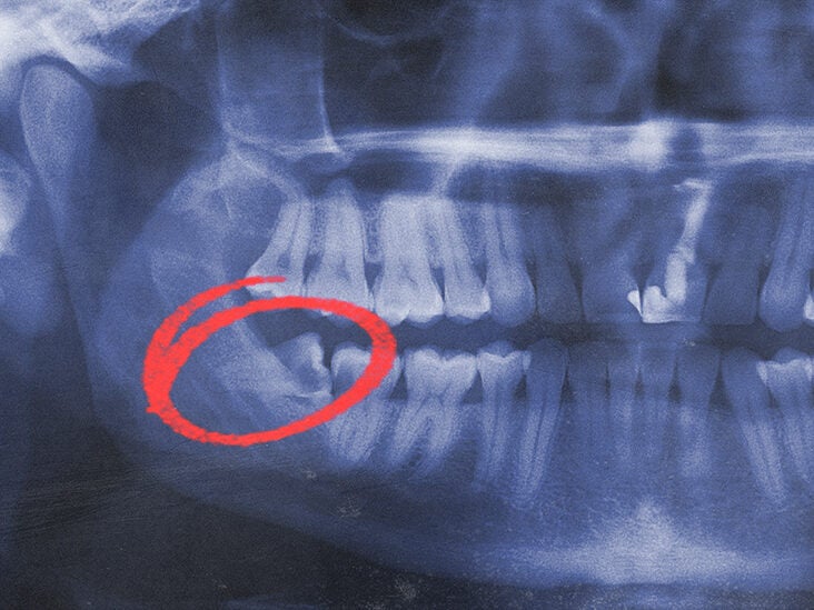 horizontal impacted wisdom teeth