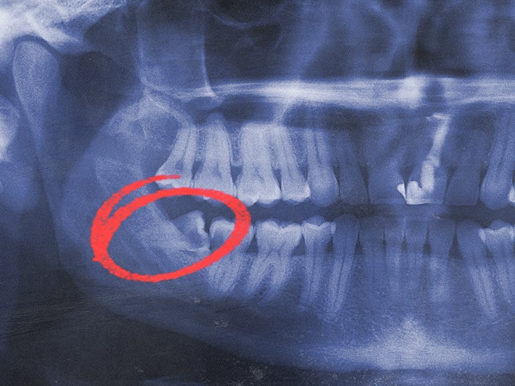 lower impacted wisdom teeth