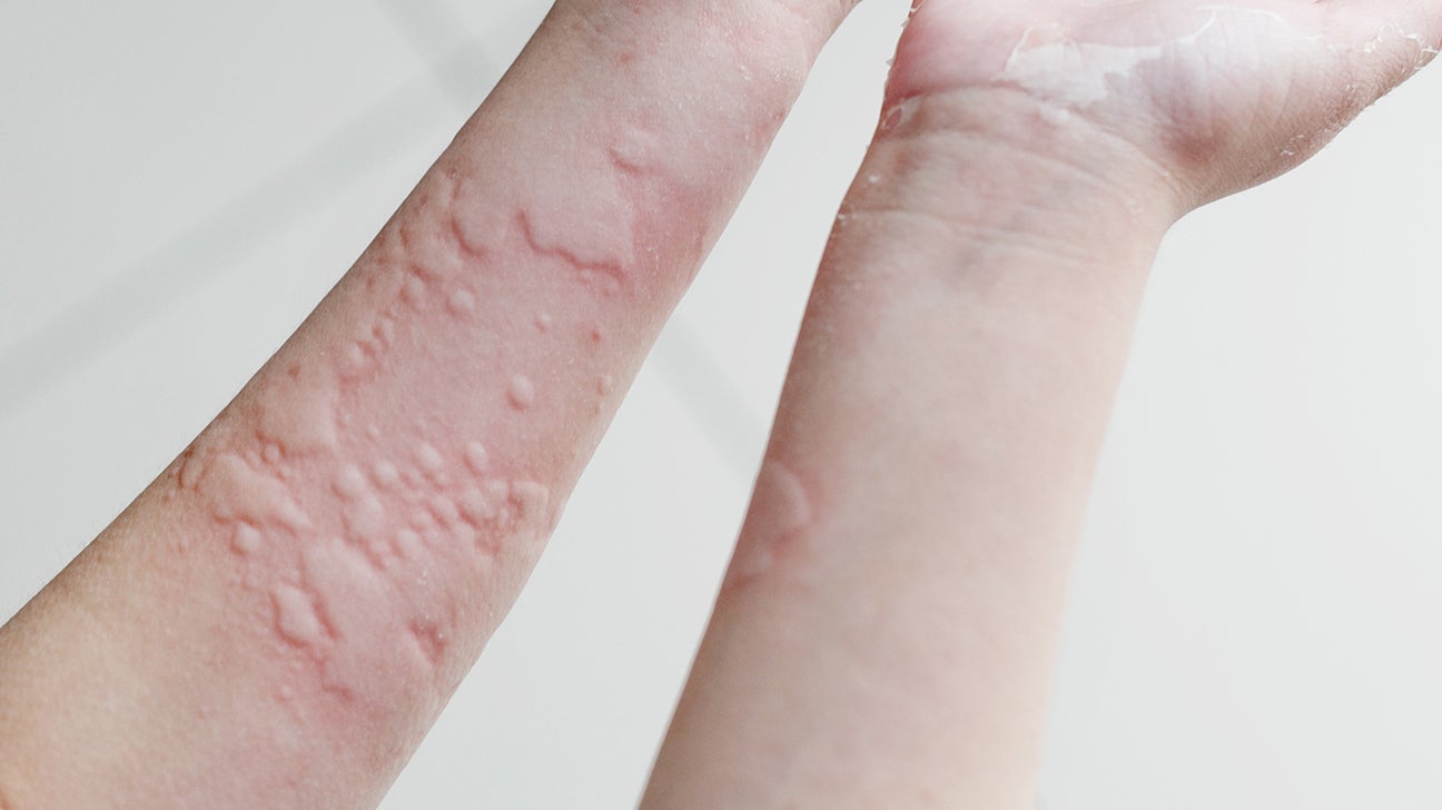 Mosquito Bites Pictures Allergic Reaction