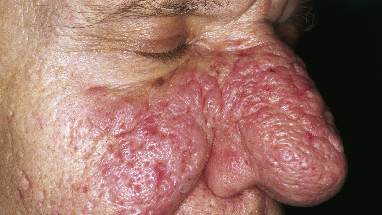 kollektion Øde Spild Rhinophyma (nose): Causes, pictures, and treatment