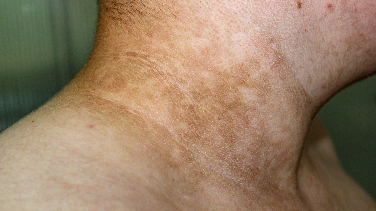 Acanthosis Nigricans In Kids: Symptoms, Pictures & Treatment