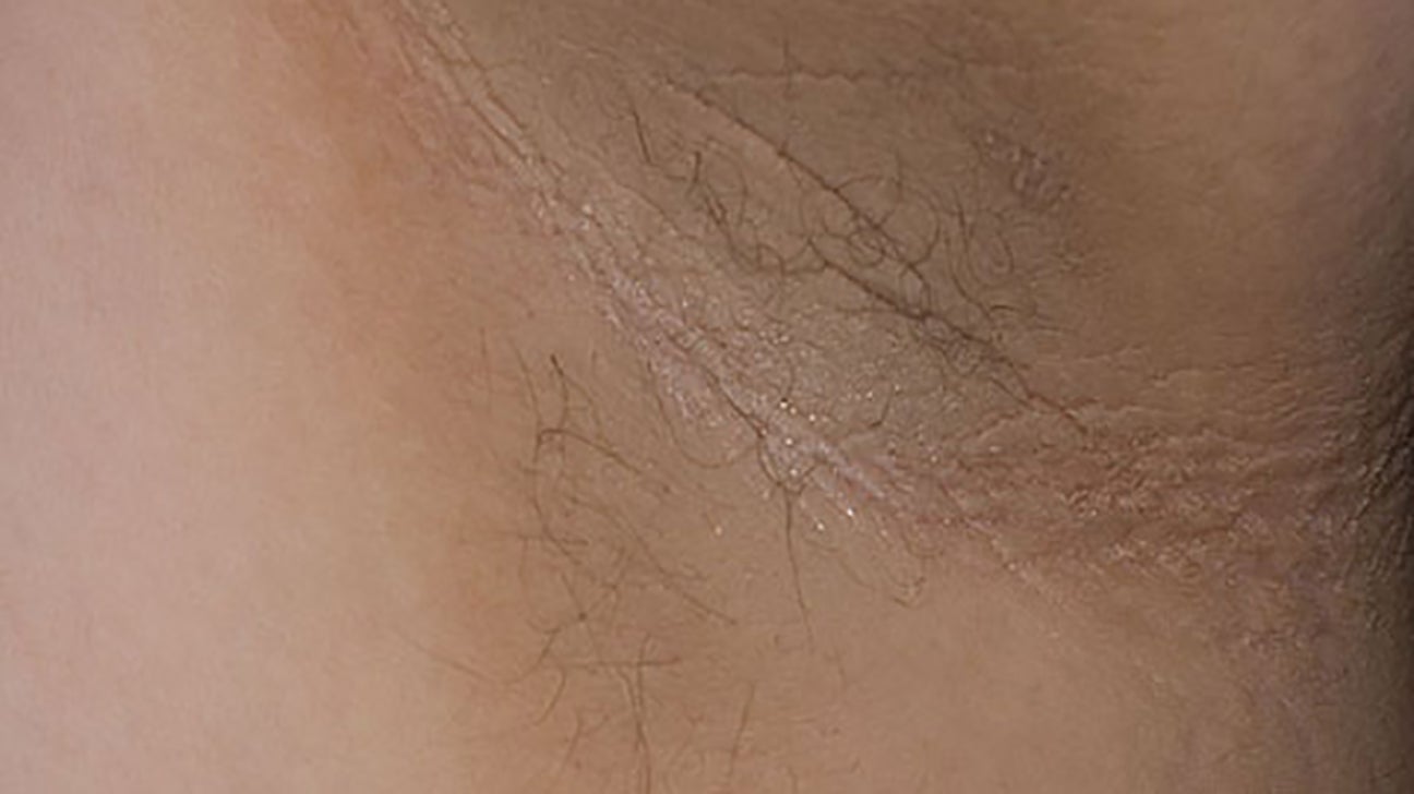 Acanthosis nigricans: Treatment, pictures, causes, symptoms, and more