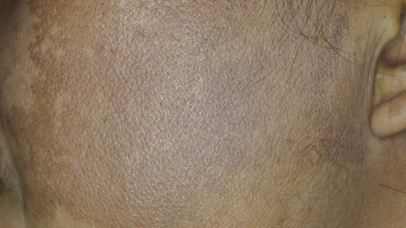 Brown patch on skin??? Under boob right on bra line. Defo been there since  I've been pregnant but might be longer. No pain or anything literally just  discoloured? - Glow Community