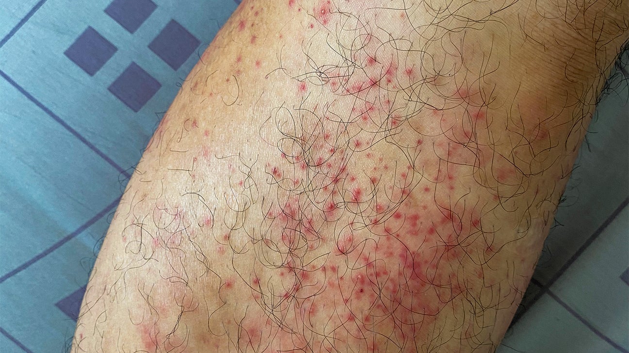 allergic reaction rash on legs