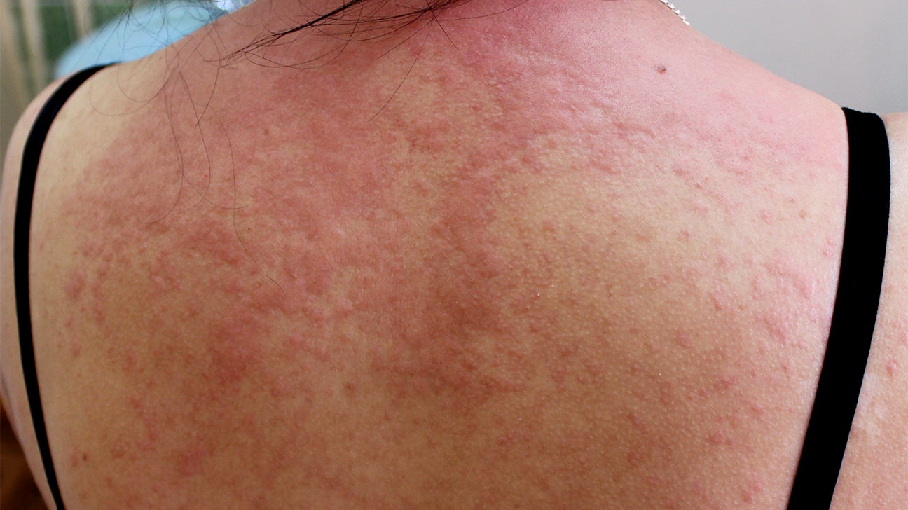 itchy skin hives