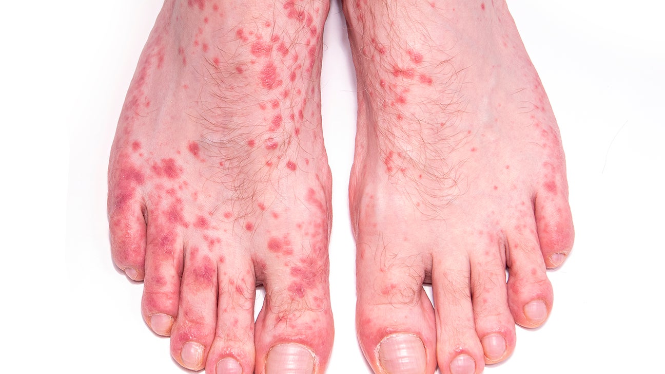 Hives urticaria Causes Pictures And Treatments 55 OFF