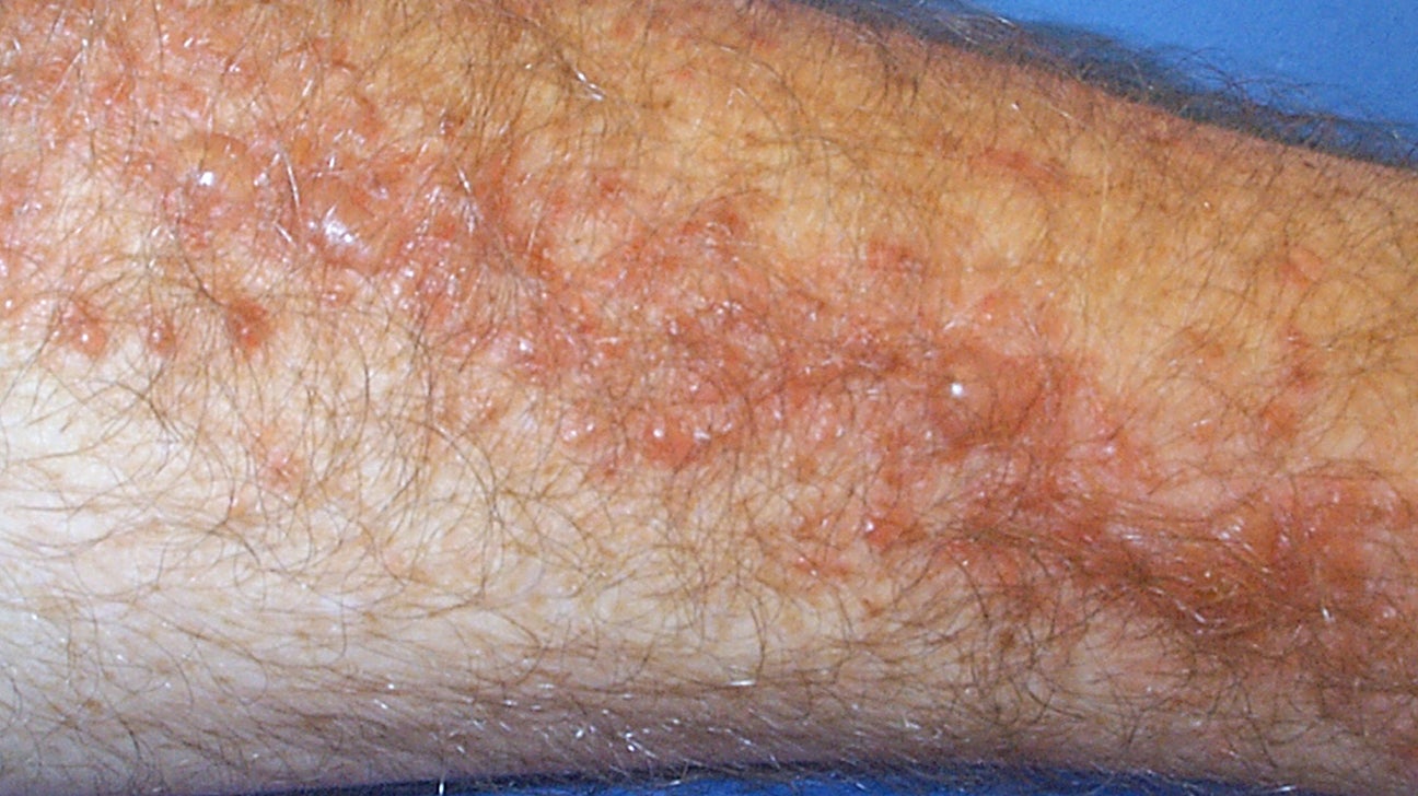 Poison Oak Rash Pictures And Treatment Poison Oak Rash Pictures And Treatment