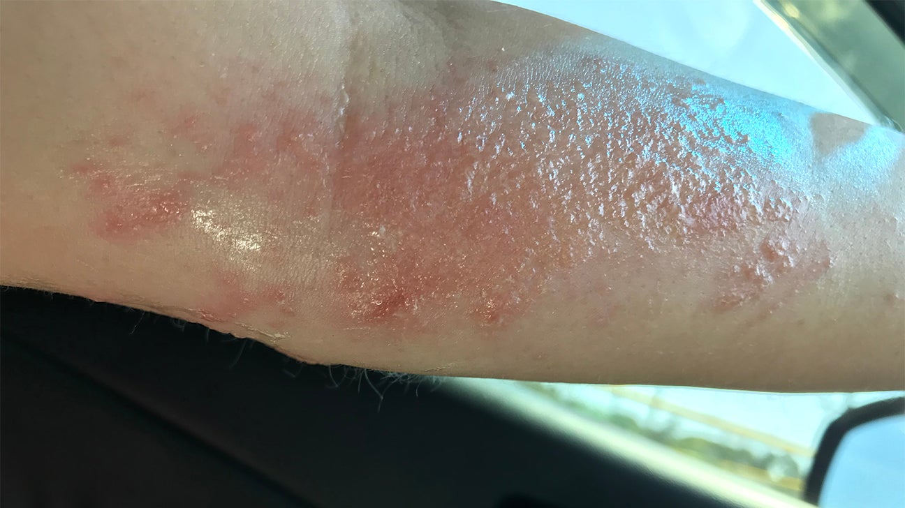 What Does Poison Ivy Look Like On Skin