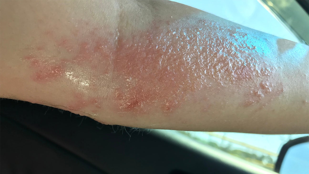 Poison Oak Rash Women Poison Oak Rash Women