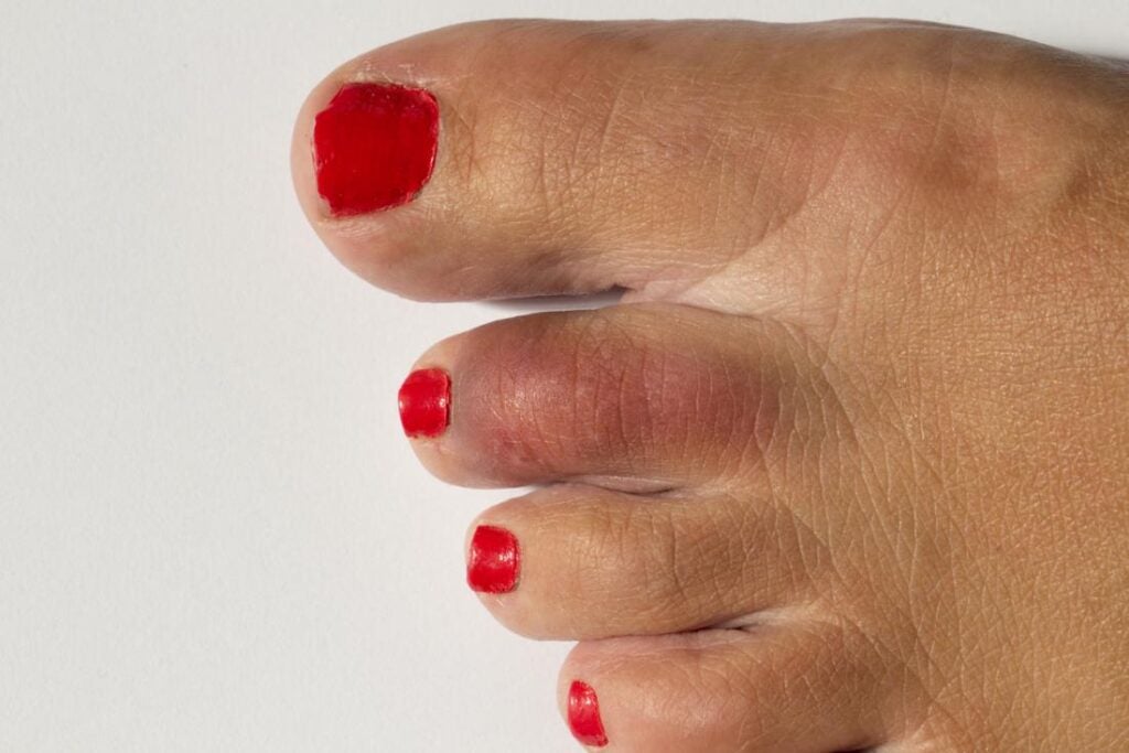 Broken toe: Treatments, symptoms, pictures, and healing time