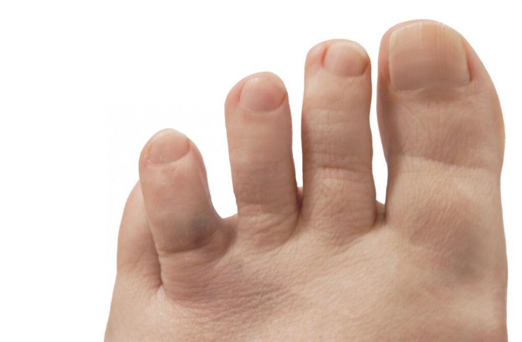 toe: Treatments, symptoms, pictures, and healing time