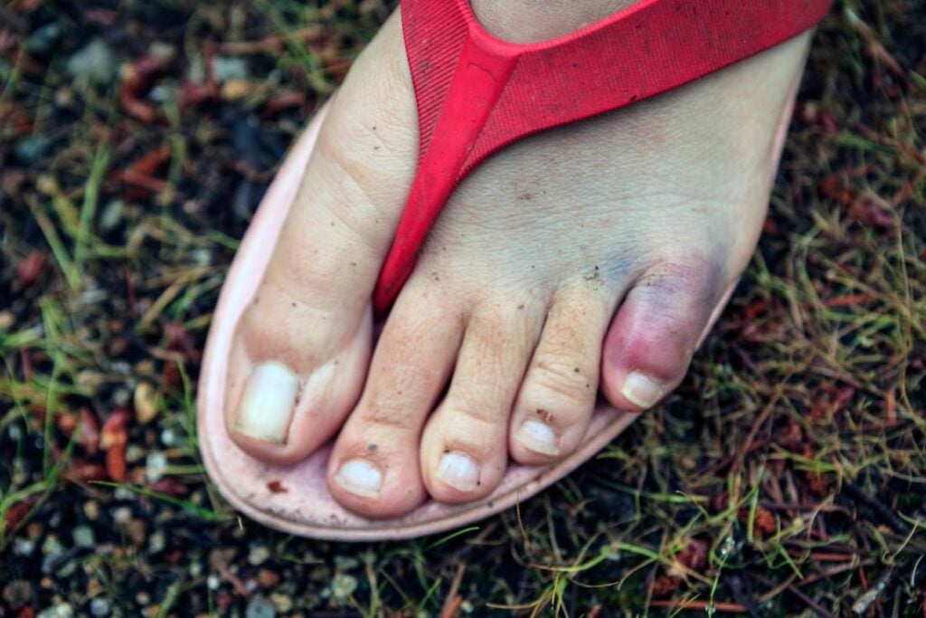 how do i know if my toe is broken