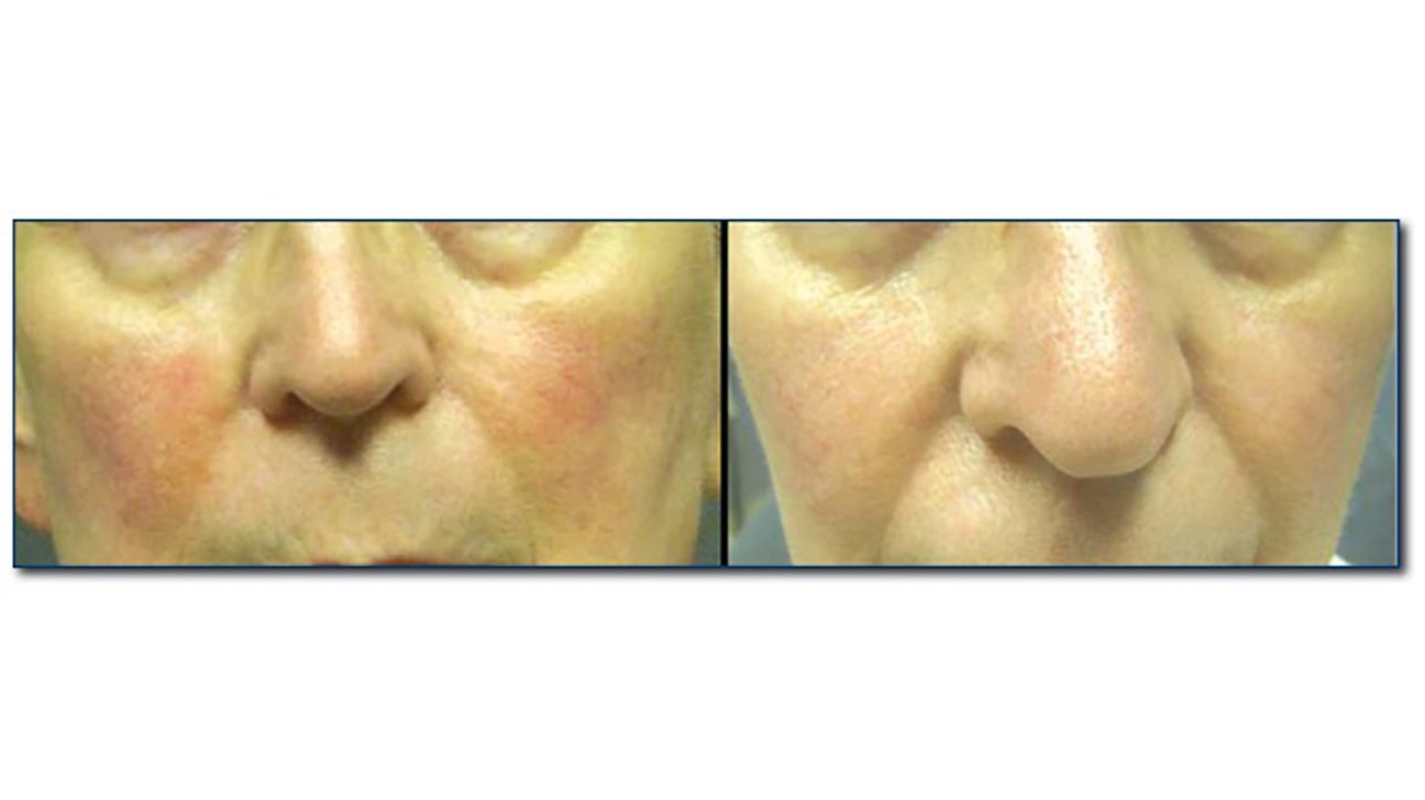 Laser treatment for rosacea Results, risks, and cost photo picture