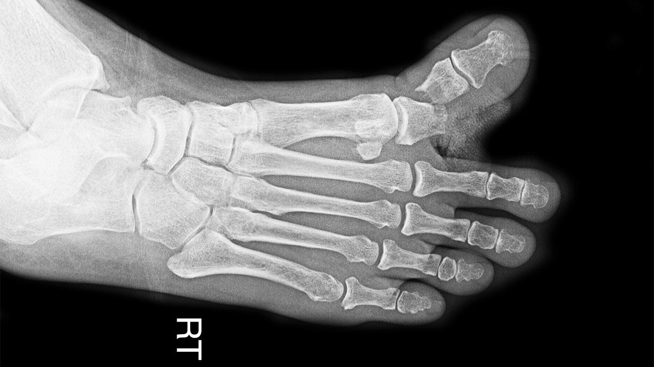 fractured toe xray