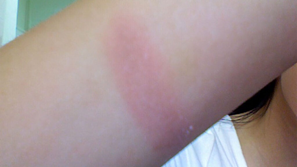 First-degree burn: Treatment, symptoms, and pictures