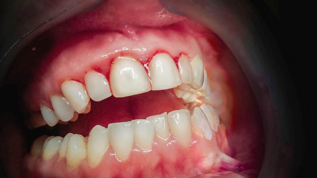 Gum infection: Causes, treatment, home remedies, and more