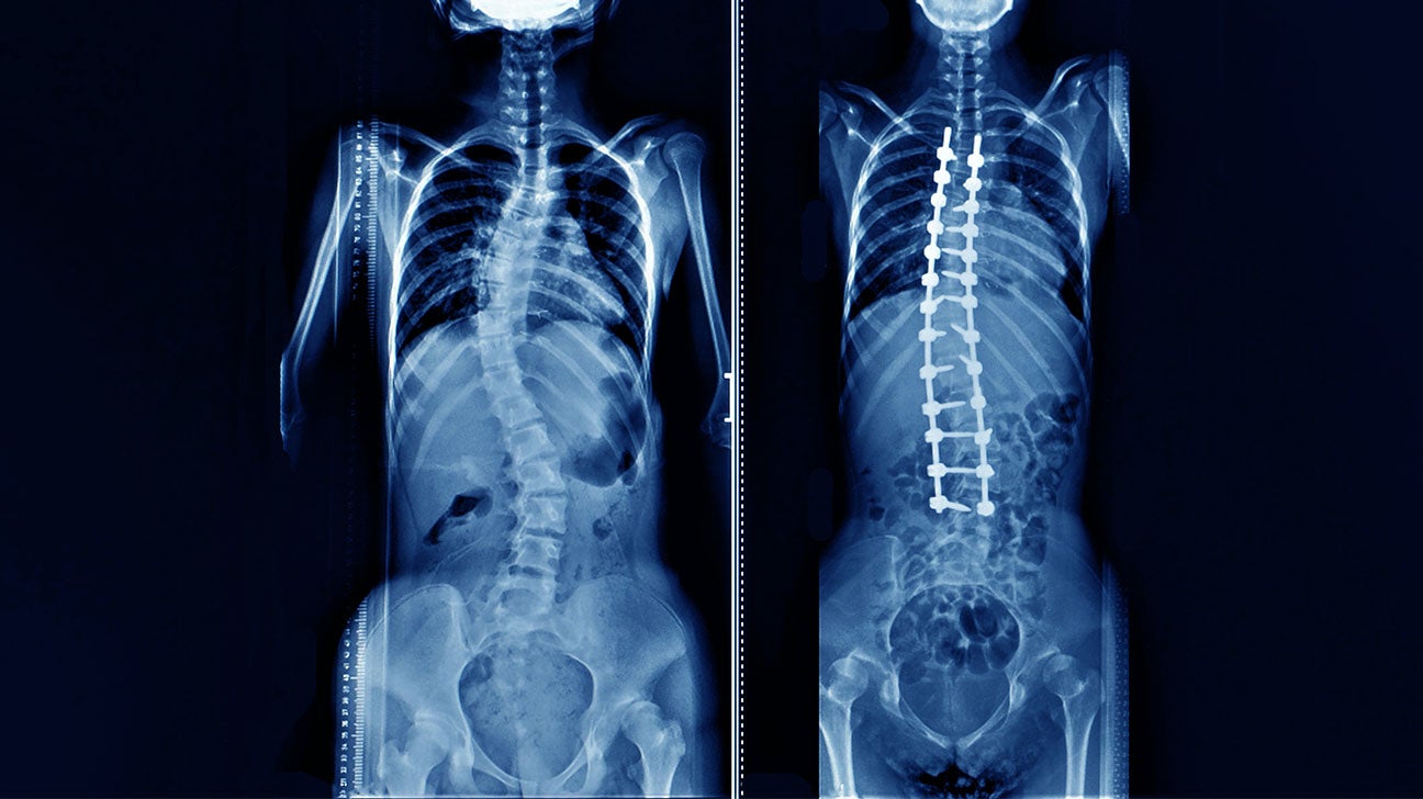 Operate Now: Scoliosis Surgery 